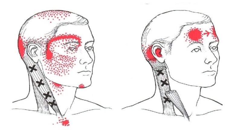 Trp Sternocleidomastoideo