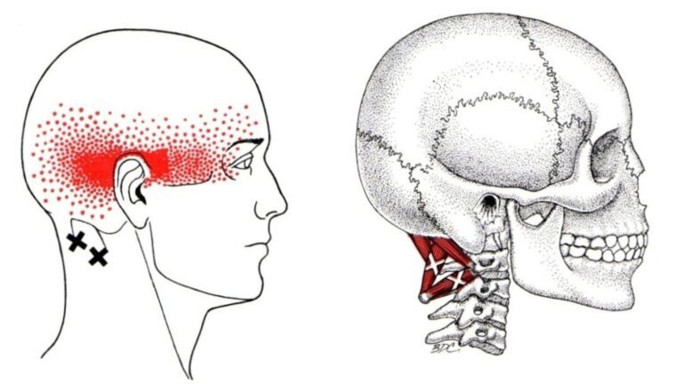 Trp trigono cervicale